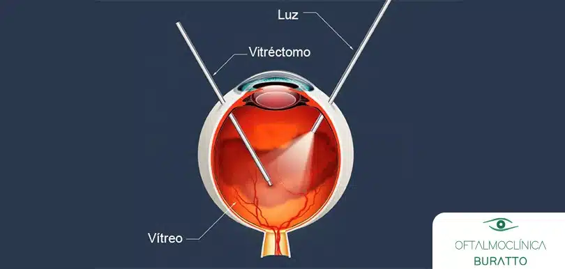 Cirurgia Retiniana e Vítreo Cirurgia Retiniana e Vítreo